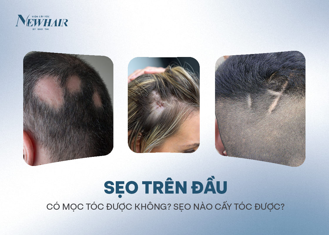 Tóc rụng có hạt trắng ở chân tóc có mọc lại không?