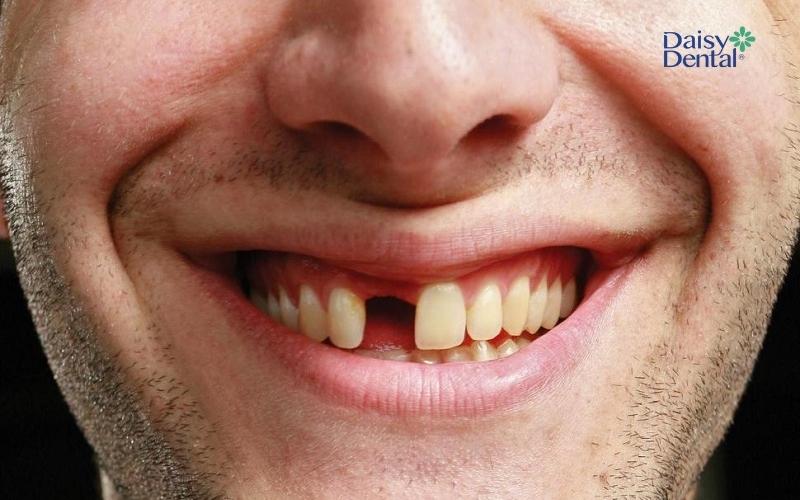 Ý nghĩa của việc nằm mơ thấy rụng răng là gì?